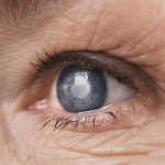 Everything You Need to Know About Cataracts