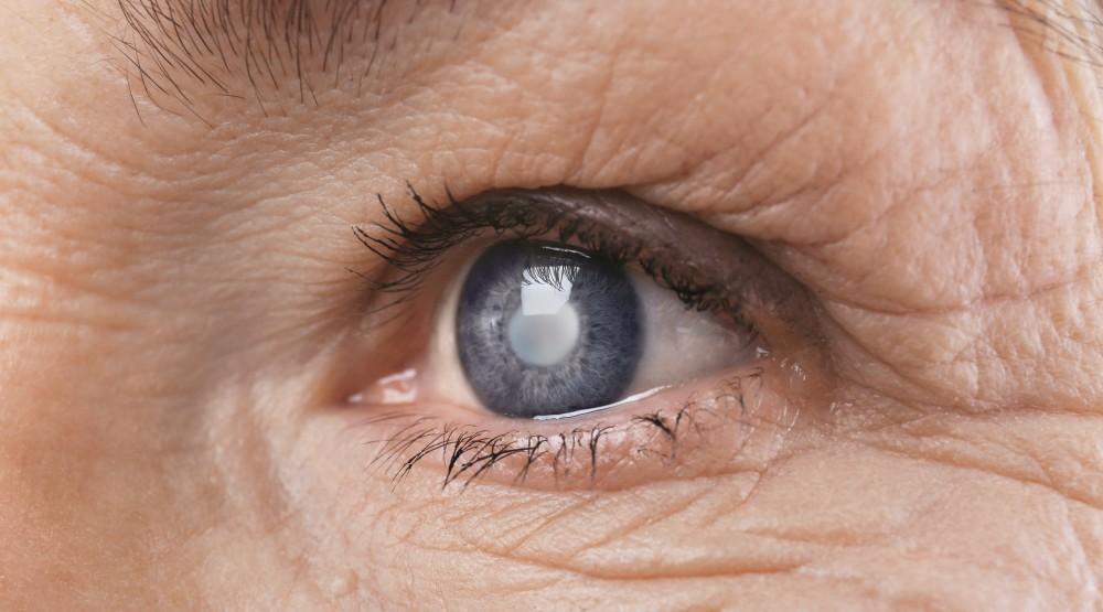 Cataract in eye