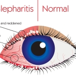 What Is Blepharitis: Causes, Symptoms, and Treatment Options